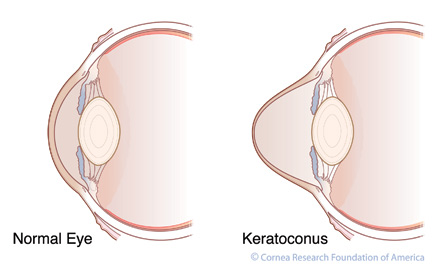 keratoconus-comp-co