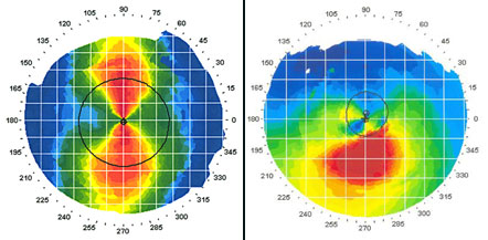 keratoconus5