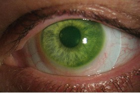 scleral-lens-on-keratoconus